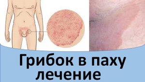 Грибок в паху лечение.