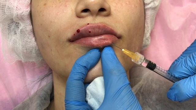 Увеличение губ:папоротниковая и парижская техника. 1ml. Нижняя губа.