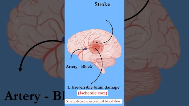 Types of brain damages during stroke and drug used. Ischemic core | Penumbra |