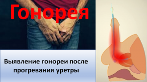 Выявление гонореи после прогревания уретры