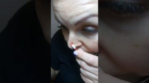 Удаление пигментного пятна на лице с помощью аппарата плазменной энергии.