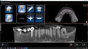 Цифровая стоматология для чайников. 7 серия. Хирургические шаблоны.