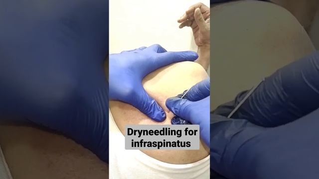 electro dryneedling for shoulder pain #ytshorts #follow #chiro #pain #foryou #for #explore #yt #yog