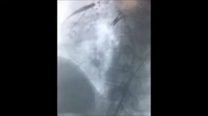 Расслаивающая аневризма аорты. Имплантация стент графта (TEVAR)