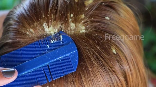 HUGE OILY psoriasis FLAKES! Scalp scratching for great relax Big Flake смотреть онлайн