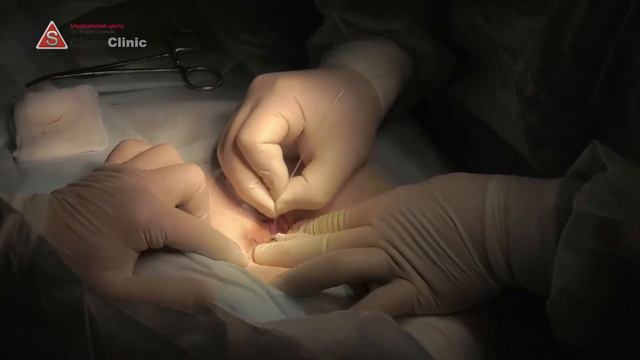 лазерное иссечение пилонидальной кисты смотреть онлайн