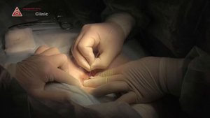 лазерное иссечение пилонидальной кисты