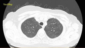 Лучевая диагностика эмфиземы легких