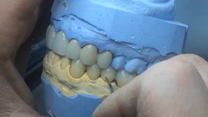 Металлокерамические мостовидные протезы