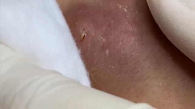 Big Pimples | Mụn Nhọt Siêu To - SacDepSpa#158