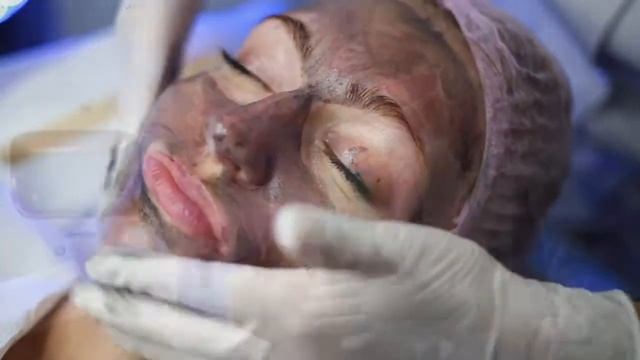 Карбоновый лазерный пилинг (Днепр) смотреть онлайн