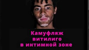 Камуфляж витилиго НА ПОЛОВОМ ОРГАНЕ. Пятна витилиго в интимной зоне. Как убрать пятна витилиго.
