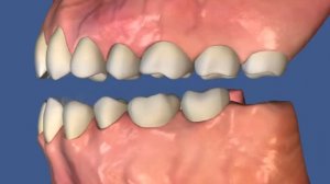 Гнатология на фоне частичной адентии и смещения зубов   Потеря нижнего 8 и экструзия антагониста