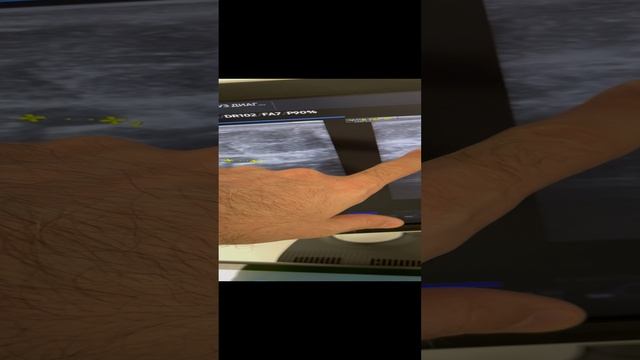 Лимфотек. Ожирение. Артроз. Отеки ног. Боли в ногах. Как лечить лимфостаз. Флеболог Москва. Флеболог смотреть онлайн