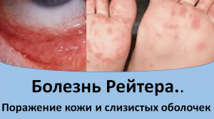 Болезнь Рейтера. Высыпания на коже и слизистых оболочках.