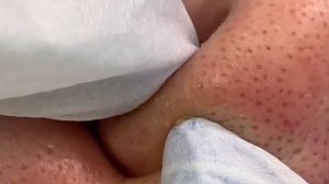 Black heads Удаление чёрных точек | Выдавливание прыщей видео Релакс