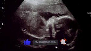 Малыш перестал шевелиться в утробе матери на 30-ой неделе. Вердикт врачей вас шокирует...