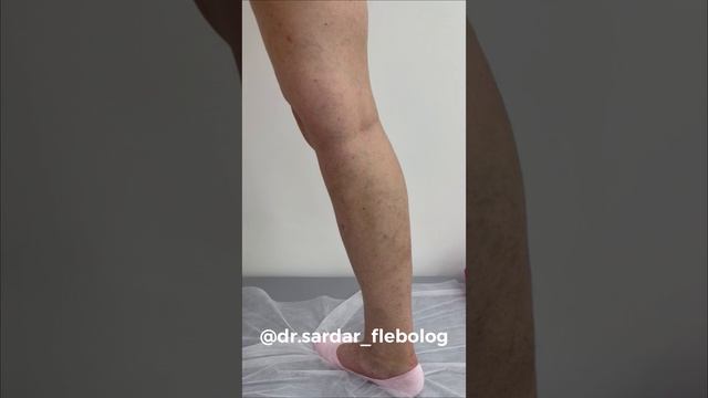 Лечение варикоза. Результат после операции. Как лечить варикоз. Флеболог Москва. Флеболог. Хирургия смотреть онлайн