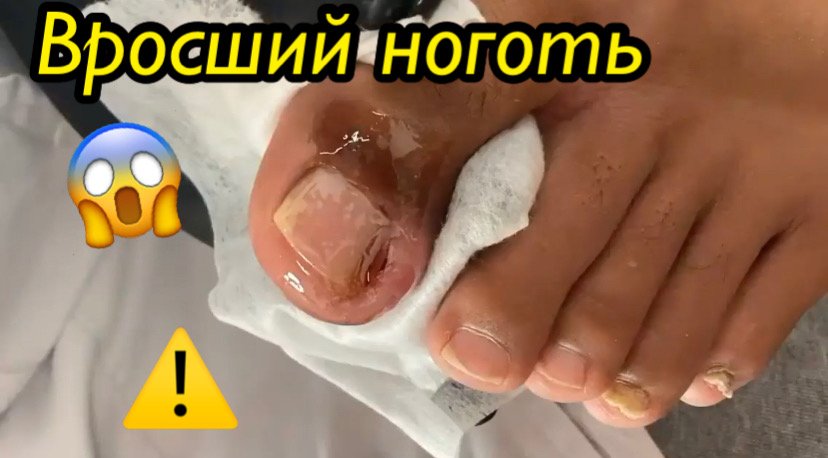 Вросший ноготь??⚠️??