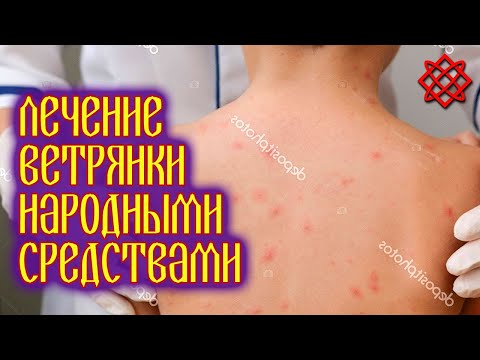 ВЕТРЯНКА У ВЗРОСЛЫХ И ДЕТЕЙ. Симптомы и Лечение Ветрянки.mp4