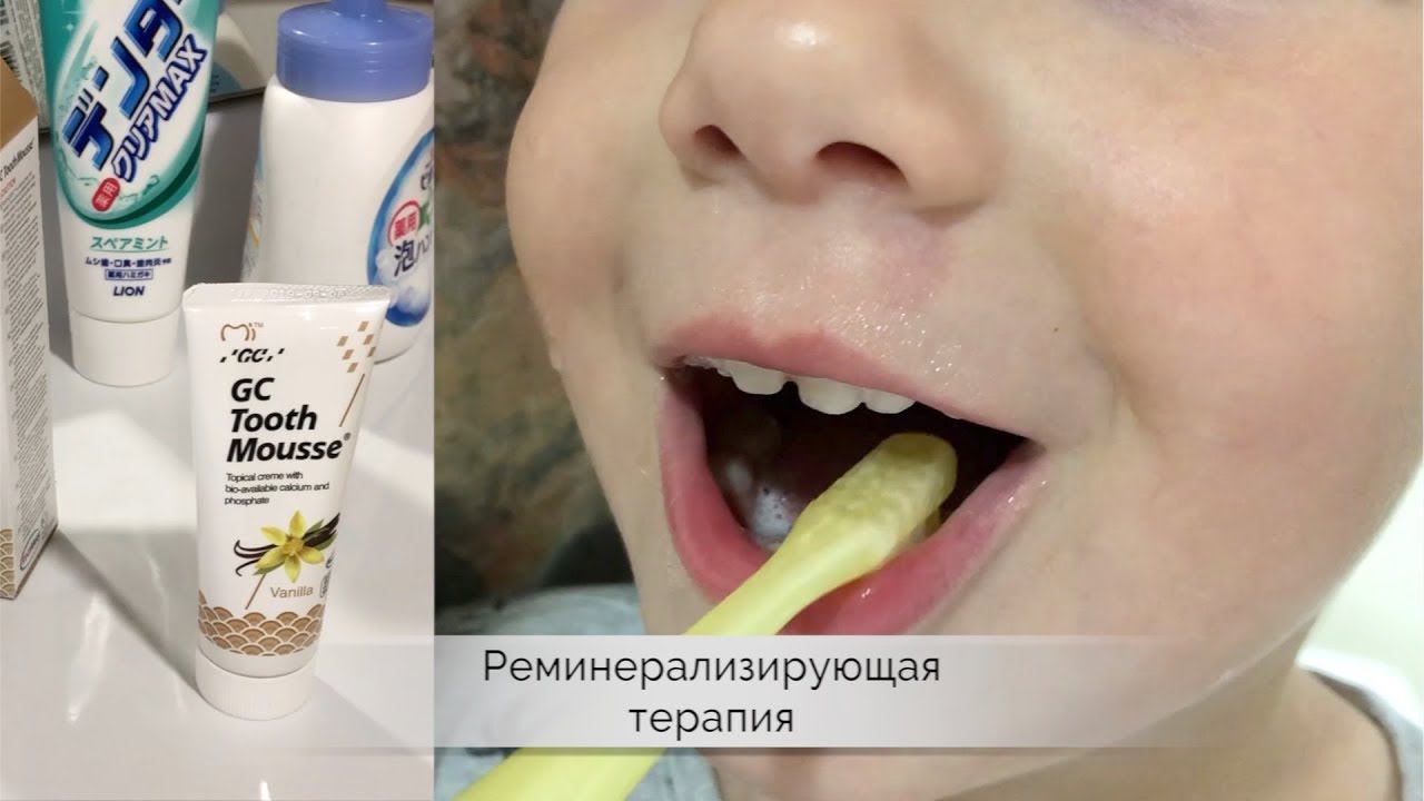 Реминерализационная терапия зубов | стоматология Самара
