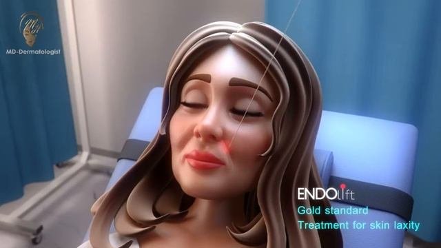 Endolift® - Non Surgical Laserlifting - Skin Tightening [Eufoton®]