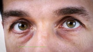 В чем причина появления темных кругов под глазами