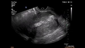 Аденокарцинома тела матки/adenocarcinoma of the uterus