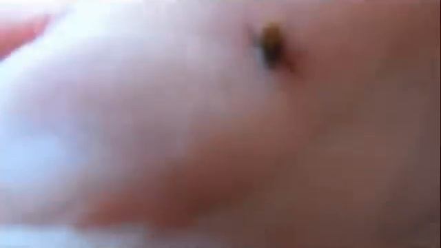 Укус клеща! Как правильно вытащить клеща. смотреть онлайн