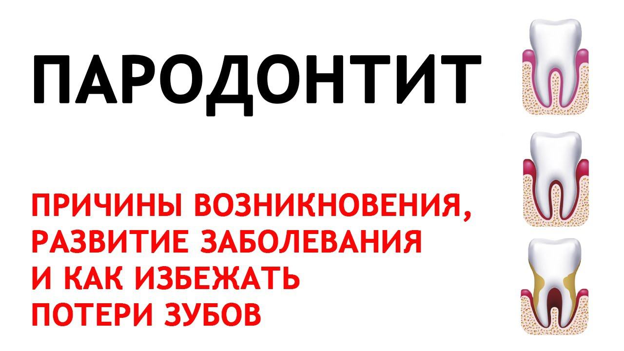 Пародонтит: о заболевании на примере реальных случаев с фото