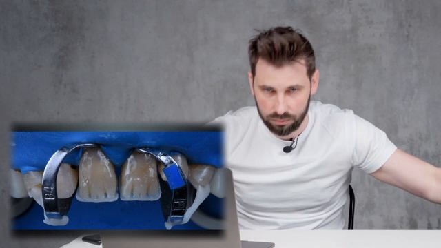 Установить 6 виниров в 84 года! Этапы реставрации. смотреть онлайн