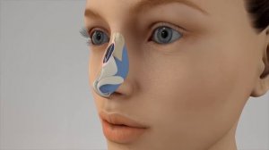 Ринопластика - удаление горбинки носа