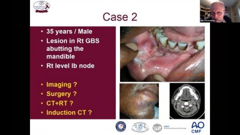 Global Oral Cancer Symposium 2020 | Advanced Oral Cancer Management: Controversies to consensus