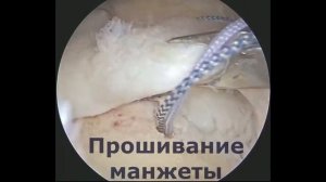 Шов ротаторной (вращательной)  манжеты плеча