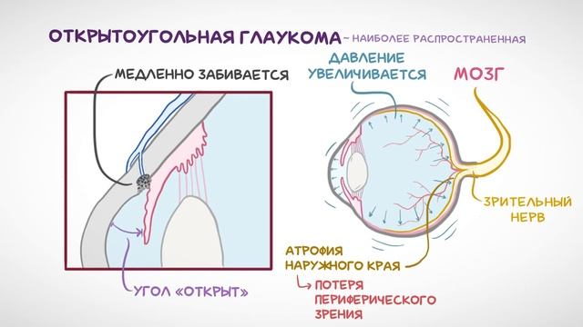 Глаукома — общая информация, виды, симптомы, диагностика, лечение
