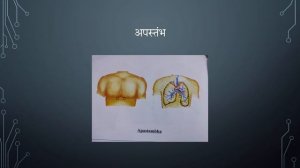 MADHYA SHAREERA MARMA|| UDARA-URAS MARMA|| MARMAS OF CHEST ABDOMEN & BACK||