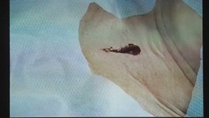 24Live Выборный МИ Пункционно дилатационная трахеостомия