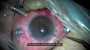 Подшивание ИОЛ. Хирургия с Кожуховым А. А. | IOL fixation.