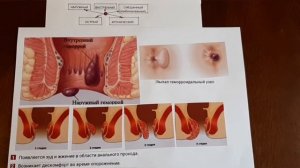 Как вылечить ГЕМОРРОЙ !!!