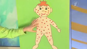 Ветряная оспа. Чем опасна ветрянка