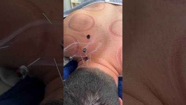 Пациент не мог повернуть голову из-за острых болей в области шеи, но после 2 сеанса ….. смотреть онлайн