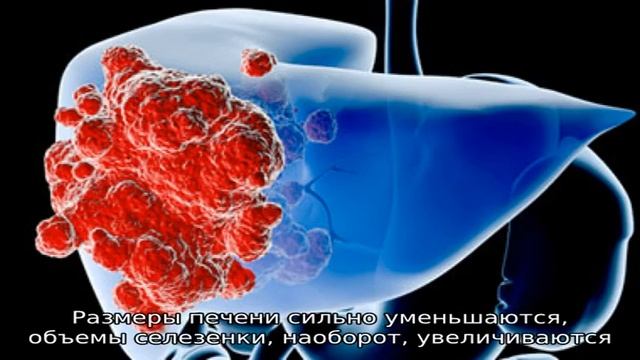 Четыре стадии цирроза печени
