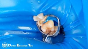 Сложная изоляция 25, преэндодонтический билдап, кламп B4, W3 DET.expert & Sanctuary 4K