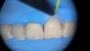 Прямая реставрация . Пришеечный кариес. Direct restoration. PART2 POLISHING. Полировка