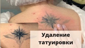 Как УДАЛИТЬ ТАТУИРОВКУ? Процесс лазерного удаления тату на спине.