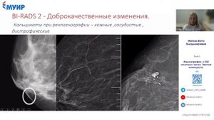 Вебинар «Маммография и УЗИ молочных желез. Тактика клинициста»