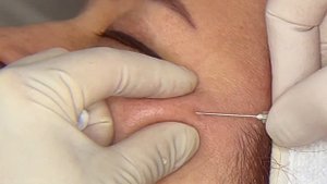 Инъекции полимолочной кислоты