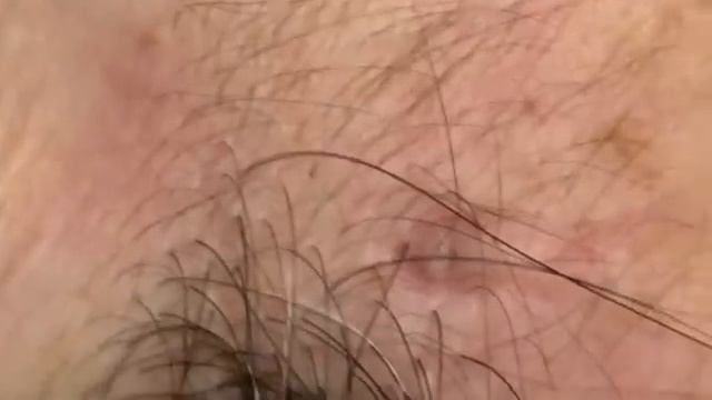 Blackheads. смотреть онлайн