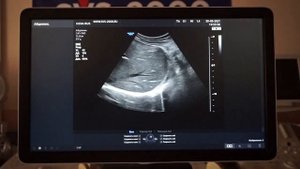 Samsung Medison HS50 обзор ультразвукового сканера