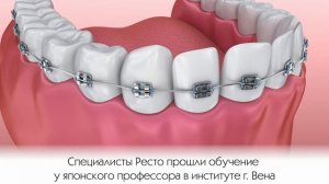 Исправление прикуса брекетами